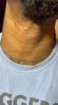 Huge pimple on my neck! follow for daily videos #pimplepopping #pimple #acne #dermatology #facial