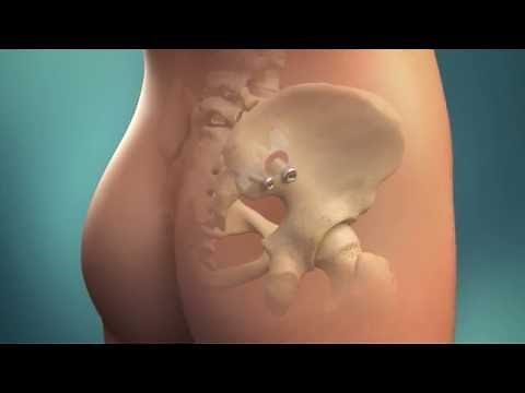 SImmetry Sacroiliac Fusion Animation