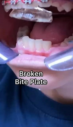 Braces Emergency: Broken Bite Plate Repair Guide