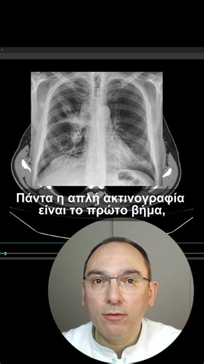 Σκιά στον πνεύμονα στην ακτινογραφία – τι μπορεί να σημαίνει;