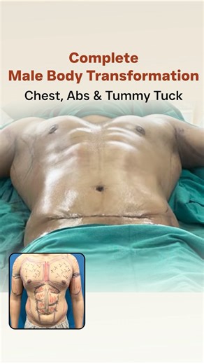 Complete Male Body Transformation | Chest, Abs & Tummy Tuck