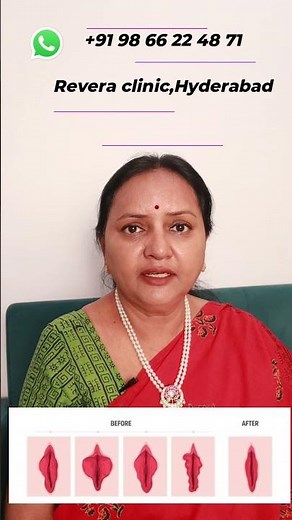 Labia minora trimming a popular cosmetic gynecologic surgery