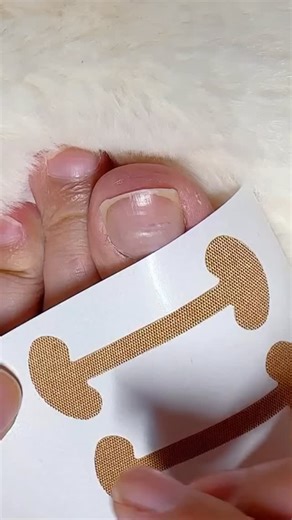 26K views · 3.6K reactions | Nails hurting? Infection problem?  Try this Paronychia Corrector – the viral nail saver everyone’s talking about!  Instant pain relief, fast healing & pure comfort  Safe, reusable & super easy to use!  #ParonychiaCorrector #NailRelief #NailInfectionCare #NailSaver #TrendingBeautyTool #NailPainSolution #HandCare #NailCareRoutine #NailFix #BeautyHack #MustTryTool #ViralNailProduct #CleanHands #NailTreatment | toecorrector.store | Facebook