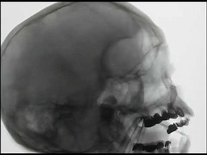 Percutaneous balloon rhizotomy for trigeminal neuralgia