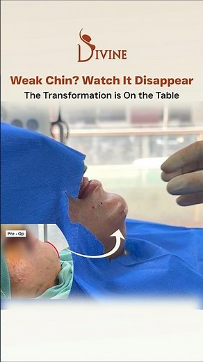 Chin Implant Transformation: Watch the Before and After & Stunning Results