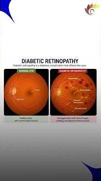 Diabetic Retinopathy Explained: Symptoms, Risks, and Prevention | Nellai Eye Care