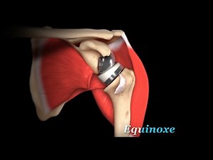Reverse Shoulder Replacement - Better Results