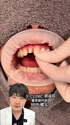 被せ物と歯を削らないラミネートベニア治療の併用症例になります🙂‍↕️✨🦷#歯医者 #おすすめ