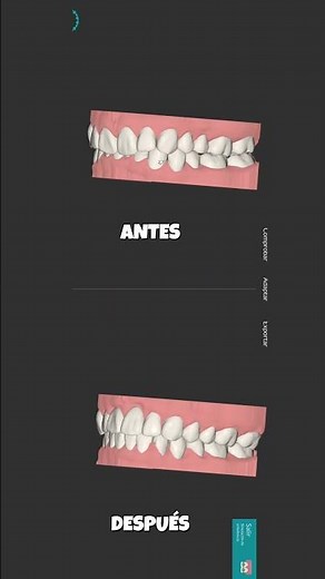 ✨ Ortodoncia Digital 3D | Simula tu nueva sonrisa en Lignum 💎 #escaneo3d #ortodoncia