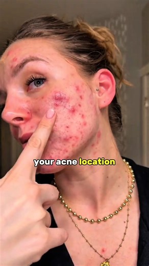 Your Acne Location Isn’t Random Here’s Why 😳