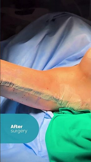 🎥 Live from the operating room: breast lift, arm lift, and armpit lift surgery.