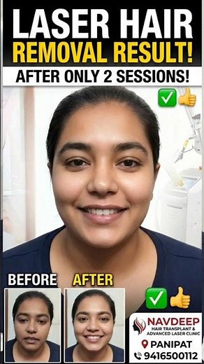 Laser Hair Removal Face Results After 2 Sessions | Patient Review Panipat