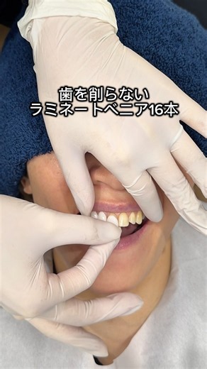歯を削らないラミネートベニア-ZERORAMI- #審美歯科 #ラミネートベニア