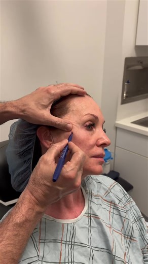 Two months after her mini facelift, our 57-year-old patient is healing well, with refined, natural results now beautifully settled. To schedule an appointment: Phone: 212-288-3000 WhatsApp: 201-875-8482 Or send us a private DM. Offices in New York City & New Jersey Virtual Consultations Available Disclaimer: We do not own or claim to own the audio in this video. All rights and permissions belong to the original creator.