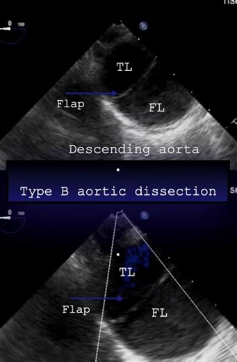 Type B aortic dissection/TEE image