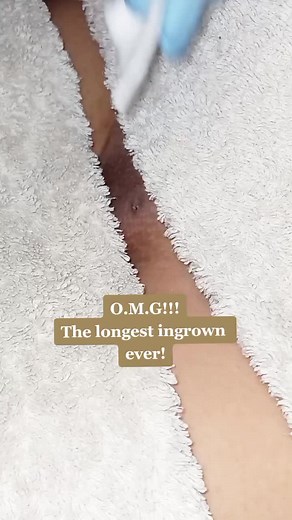 TW: Pubic area, hair removal, ingrown hair #hairremoval #ingrownhairremoval #fyp #fyppppppppppppppppppppppp #foryou #foryoupage #foru #hair #ingrowns #Hollywood #waxing #extraction #viral #trend