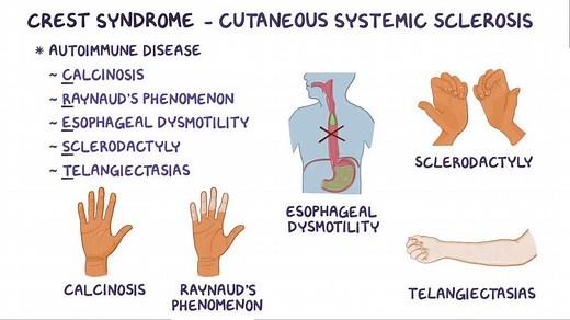 Video: Limited systemic sclerosis (CREST syndrome) - Video Explanation! | Osmosis | Osmosis