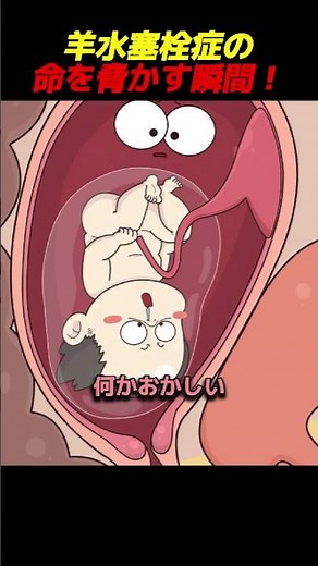 羊水塞栓症の命を脅かす瞬間！