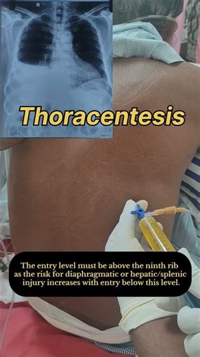 Thoracentesis || Pleural tap || Pleural Fluid Aspiration || Diagnostic thoracentesis #shorts #viral