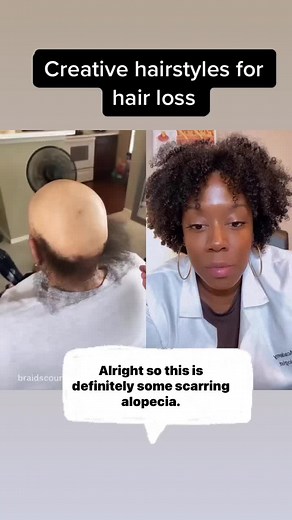 Creative Hairstyle for Women with Scarring Alopecia