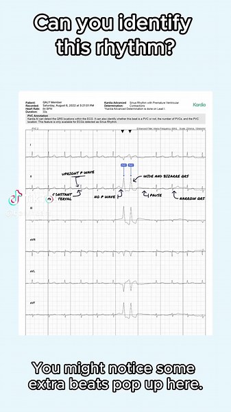 Qaly | ECG Reader na TikTok