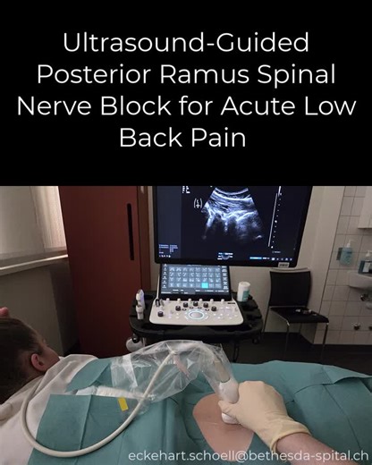 Ultrasound-Guided Posterior Ramus Block of the Lumbar Spinal Nerve Acute low back pain (LBP) is one of the most frequent reasons for presentation to the ED. In our ED, selected patients are treated… | Eckehart Schöll