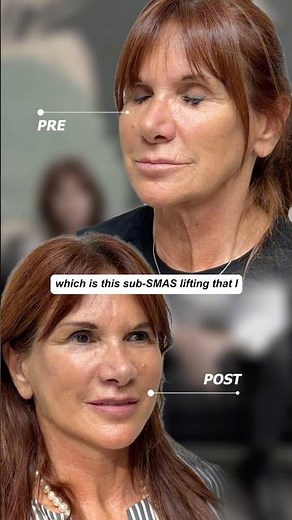 Advanced Facial Aesthetics & HDS Thread Lifting