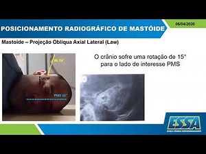 POSICIONAMENTO RADIOGRÁFICO 2 MASTÓIDE