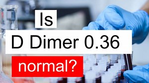 Is D Dimer 0.36 normal, high or low? What does D Dimer level 0.36 mean?