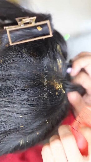Very Huge Dandruff Flakes Scratching From Scalp With Comb by Miss.Dandruff by doctor #removetick #Dandruff #dandrufftreatment #dandruffremoval #fblifestyle | Gabriela Blair