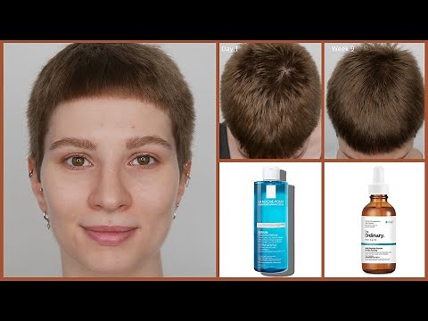 The Ordinary Hair Serum with La Roche Posay Kerium Extra Gentle Shampoo | 9 Weeks Results