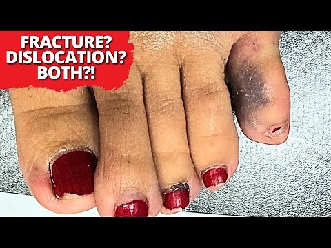 Broken AND Dislocated Toe – Here’s What Happened