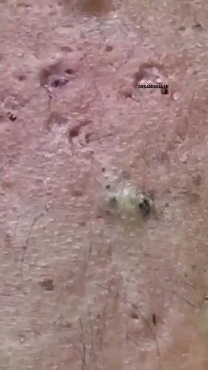 One Back, Hundreds of Blackheads Removed #popping #asmr