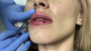 1K views | Click Hd Just BEAUTY ART AESTHETICS LIPS #Tehnici #exlusive #de #injectare #Kylie #Jenner #HOLLYWOOD #lips #LUXURY #CLINIQUE #JUVEDERM#MY #VIBRATTA Programări &Info:0722296007 | Clinica Beauty Art Aesthetics | Facebook