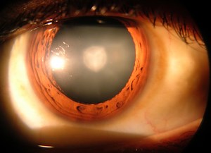 My Cataract Surgery and How Much Crystalens Cost