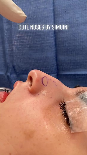 Cute rhinoplasty by Dr Payman Simoni #nosejobcheck #nosejobchallenge #beforeandafter #fyp #foryoupage #OutfitChange #ThisIsBliss #GetFit #ACupgrade