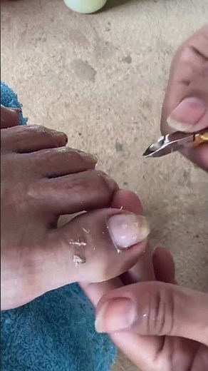 Toenail fungus home remedies