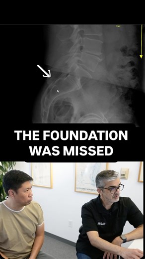 This is why some “herniated disc” cases never heal. Frank flew from Texas to Los Angeles after 15 years of back pain that began from lifting a heavy case of bottled water. He was told he had a herniated disc and tried physical therapy and other conservative care — without results. After a detailed Gonstead exam and full-spine X-ray review, Dr. Rahim Salehmohamed found the real issue wasn’t just the disc, it was the foundation of the spine. Frank has a transitional lumbar pattern, something seen