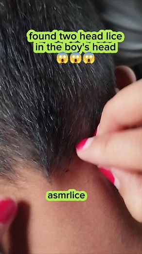 42K views · 149 reactions | #satisfying #AsmrLice #Lice #piojos #KUTO #RemovalLice #poux #KutuRambut #HairTreatment #asmrsound #LiceVirals | Irawati Muskin | Facebook
