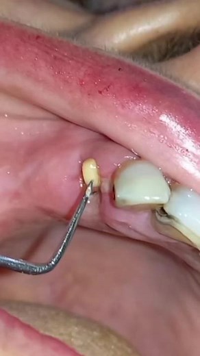 Uneventful healing needs proper wound care after tooth removal #postextraction #care #dentist #drbiplob #tooth #extraction #socket #dentist #drbiplob #दन्त #दन्तस्बास्थय #premierdentalnepal #प्रिमियरडेन्टल #oral #health #awareness #nepali