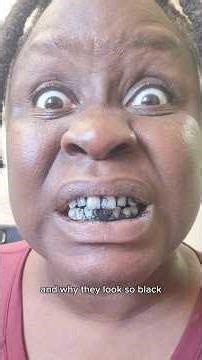 Why are my teeth so BLACK? 😱