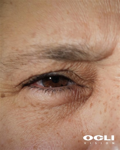 OCLI Vision on Instagram: "Fact: Being legally blind does not mean total blindness. In the United States, legal blindness is defined as: 👉Vision of 20/200 or worse in the better eye with corrective lenses 👉Or a visual field of 20 degrees or less Many people who are legally blind still have usable vision, and the term is a classification for vision standards rather than complete loss of sight."