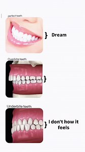 Overbite vs. Underbite: Understanding Different Teeth Types