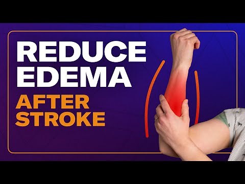 Exercises To Reduce Swelling/Edema In The Arm And Hand After Stroke