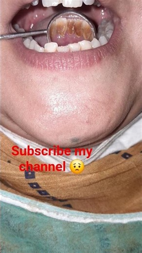 Extreme Plaque Removal | Professional Teeth Scaling #satisfying #dentist