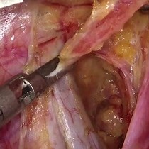 Video: Mapeo y biopsia de ganglio linfático centinela para el cáncer de endometrio en estadio temprano con laparoscopia