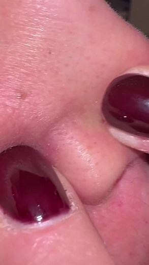 #blackpimples #pimples #pimple #satisfying