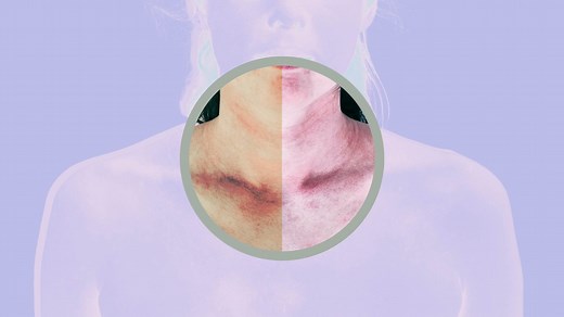 Do You Have Atopic Dermatitis or Eczema? Here's How To Tell