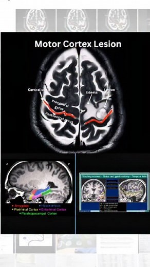 The Brain's Landscape: Sulci & Gyri Motor Lesion Mapping the Brain's Cortex. This MRI beautifully shows the peaks (gyri) and valleys (sulci) that define the brain's surface. These folds are crucial, increasing surface area for higher cognitive functions. The arrow points to a lesion located specifically on the precentral gyrus—the primary motor cortex. Damage here directly affects voluntary movement. . . #Neuroanatomy #collaboration #graduation #SulciAndGyri #Radiology #Neurology #competition #M