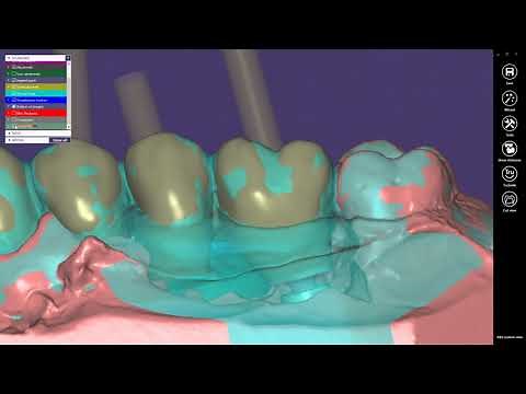 How to model temporary crowns & bridges in exocad